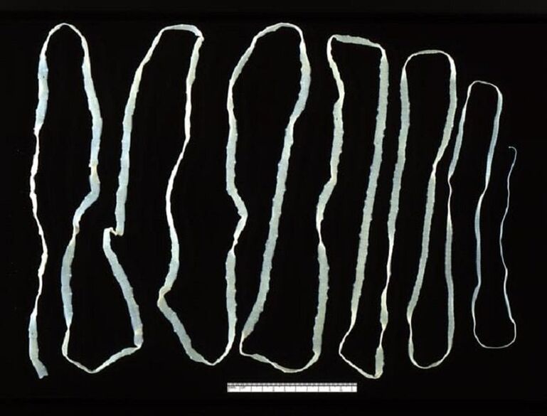 tapeworm removed from human intestine