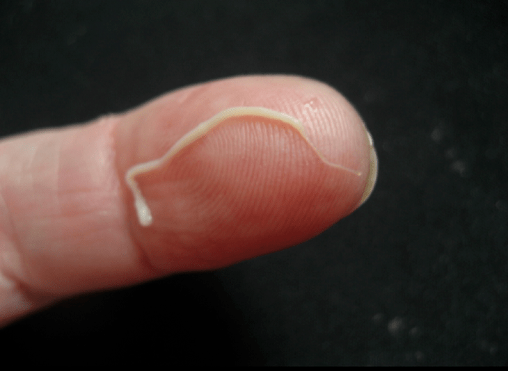 roundworm parasites from human body